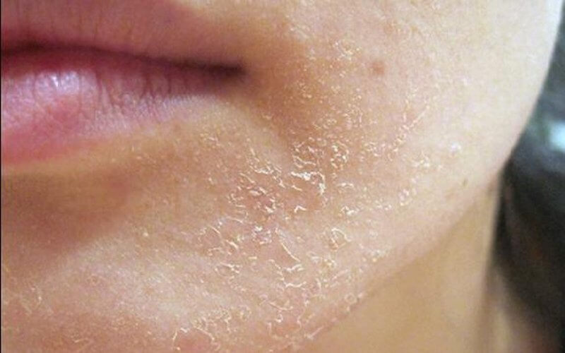 Da khô là gì ? Nguyên nhân, biểu hiện và cách chăm sóc 2 Da khô là một loại da phổ biến