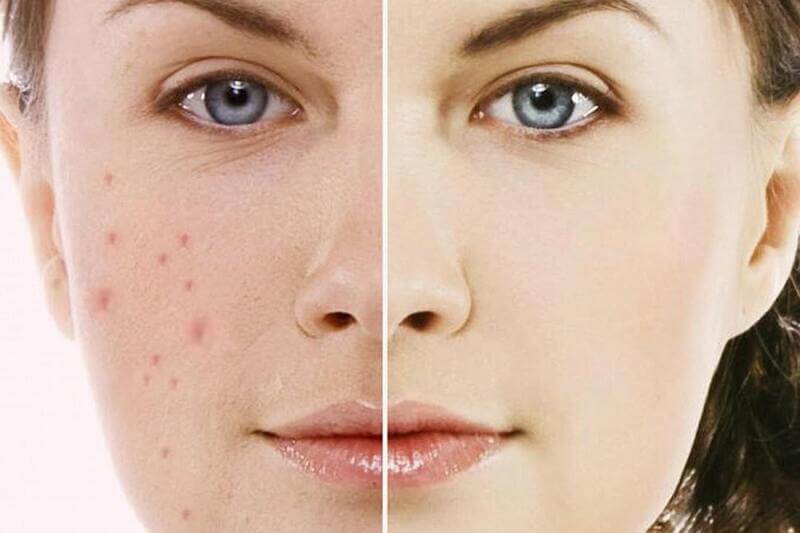 Ăn gì trị thâm mụn ? Top 5 thực phẩm nên ăn 1 Ăn gì trị thâm mụn? Top 5 thực phẩm nên ăn