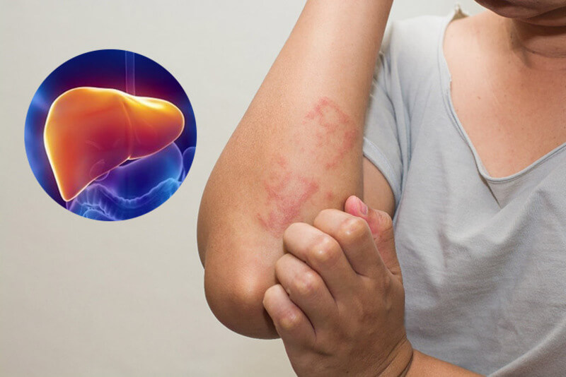 Nóng gan gây mụn nội tiết 