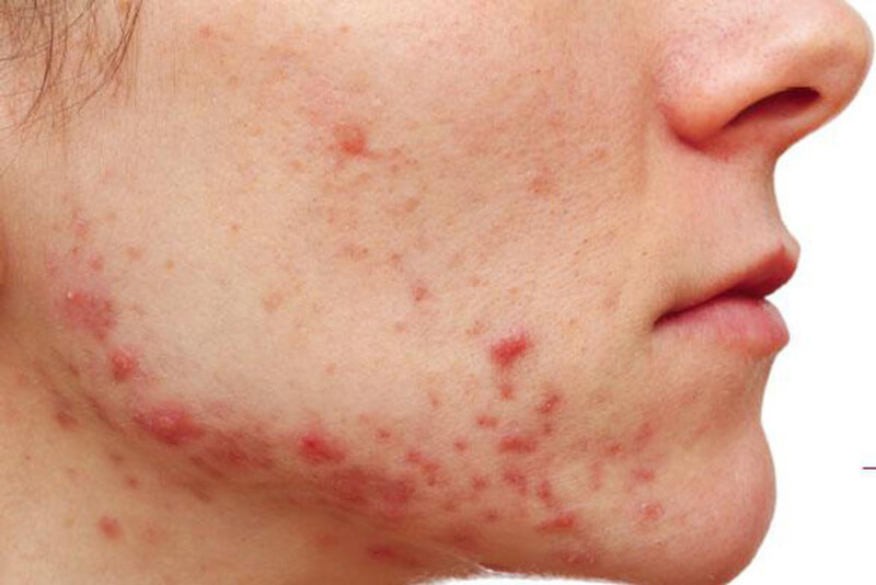 Quai hàm là một trong các vị trí nổi mụn thường thấy