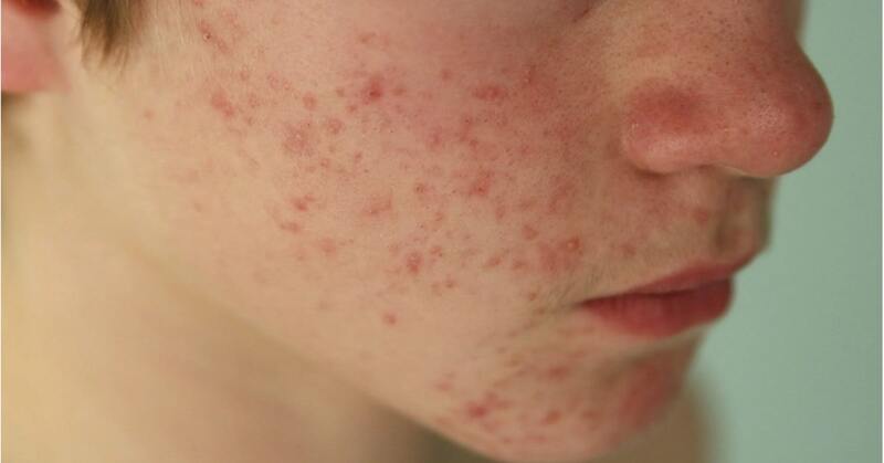 Mụn nội tiết: Nguyên nhân, dấu hiệu nhận biết và cách điều trị