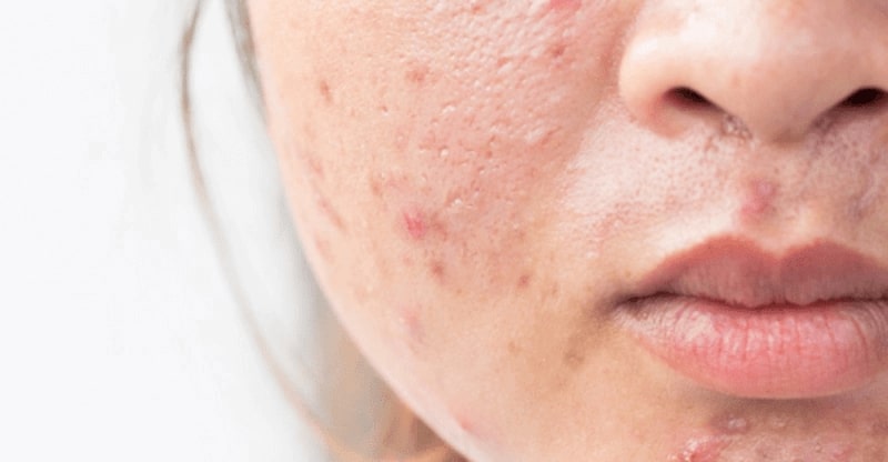 Mụn thâm đỏ là gì ? Nguyên nhân và cách điều trị 1 Mụn thâm đỏ: Nguyên nhân và cách điều trị