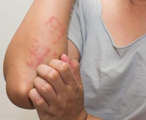 Nổi mề đay: Nguyên nhân, dấu hiệu và cách điều trị