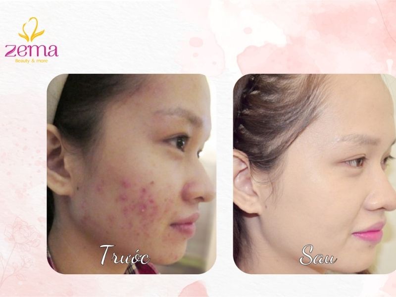 Trị mụn hiệu quả bằng laser giúp làn da hết mụn trở nên trắng sáng