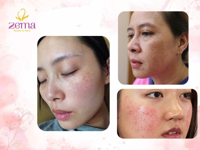 Cần cẩn thận hơn khi chăm sóc da mụn hằng ngày