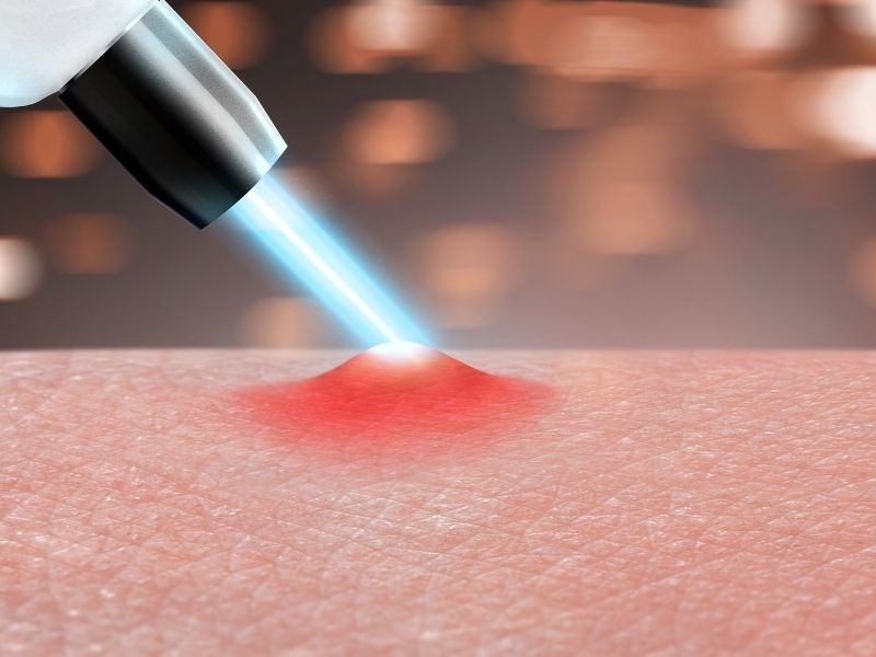 Ánh sáng laser trị mụn