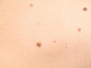 6 cách tẩy nốt ruồi tại nhà khiến chị em không khỏi tấm tắc khen ngợi 5 6 cách tẩy nốt ruồi tại nhà khiến chị em không khỏi tấm tắc khen ngợi