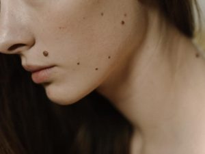 Cách trị sẹo khi tẩy nốt ruồi an toàn hiệu quả phù hợp với mọi lứa tuổi 4 Cách trị sẹo khi tẩy nốt ruồi an toàn hiệu quả phù hợp với mọi lứa tuổi