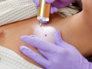 Bí kíp chăm sóc da sau khi tẩy nốt ruồi giúp bạn có kết quả mỹ mãn nhất 7 Bí kíp chăm sóc da sau khi tẩy nốt ruồi giúp bạn có kết quả mỹ mãn nhất