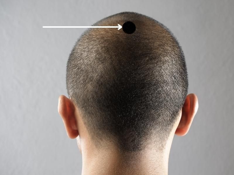 Nốt ruồi trên đầu trong tóc có ý nghĩa như thế nào