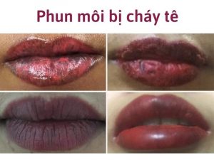 Phun môi bị cháy tê và nguyên nhân gây ra ai cũng phải cảnh giác 9 Phun môi bị cháy tê và nguyên nhân gây ra ai cũng phải cảnh giác