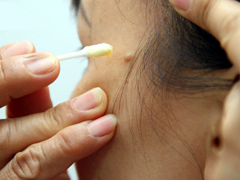Tẩy nốt ruồi có để lại sẹo không và những điều bạn cần biết 2 Tẩy nốt ruồi tại nhà có để lại sẹo không