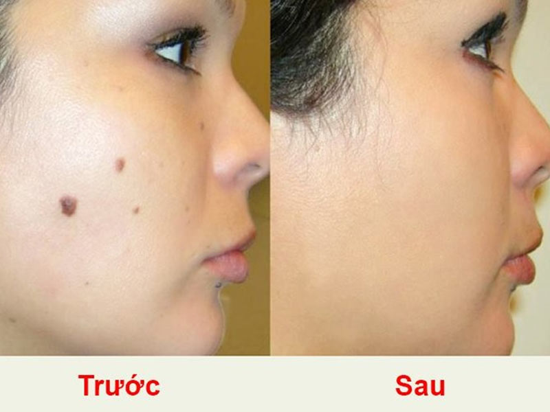 Tẩy nốt ruồi có để lại sẹo không và những điều bạn cần biết 4 Hiệu quả khi dùng công nghệ tẩy nốt ruồi