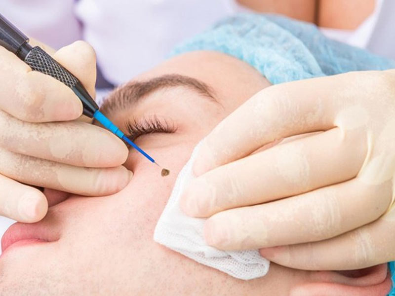 Tẩy nốt ruồi có để lại sẹo không và những điều bạn cần biết 1 Sau khi tẩy nốt ruồi có để lại sẹo không