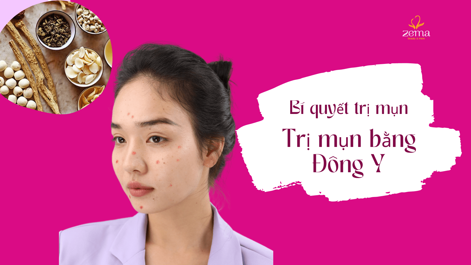 Trị mụn bằng Đông y và Những điều bạn cần biết? 5 Trị mụn bằng Đông y và Những điều bạn cần biết?