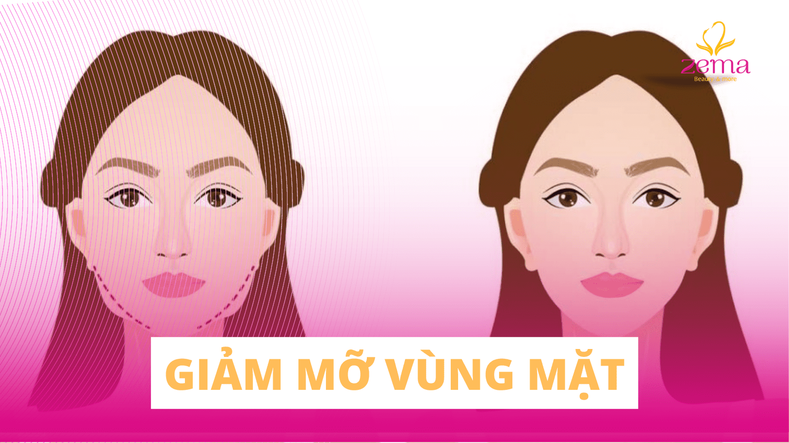 Giảm mỡ vùng mặt: Tác nhân gây mỡ vùng mặt và cách khắc phục